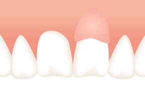 歯ぐきの再生治療（結合組織移植術）